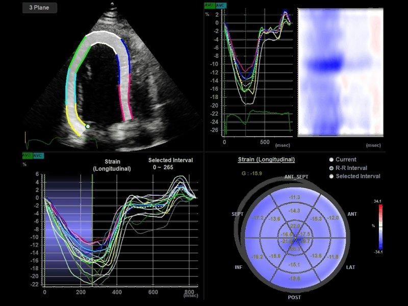 Сердце, Strain+ (эхограмма №797)