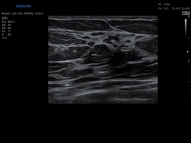 Молочная железа, B-режим (эхограмма №807)