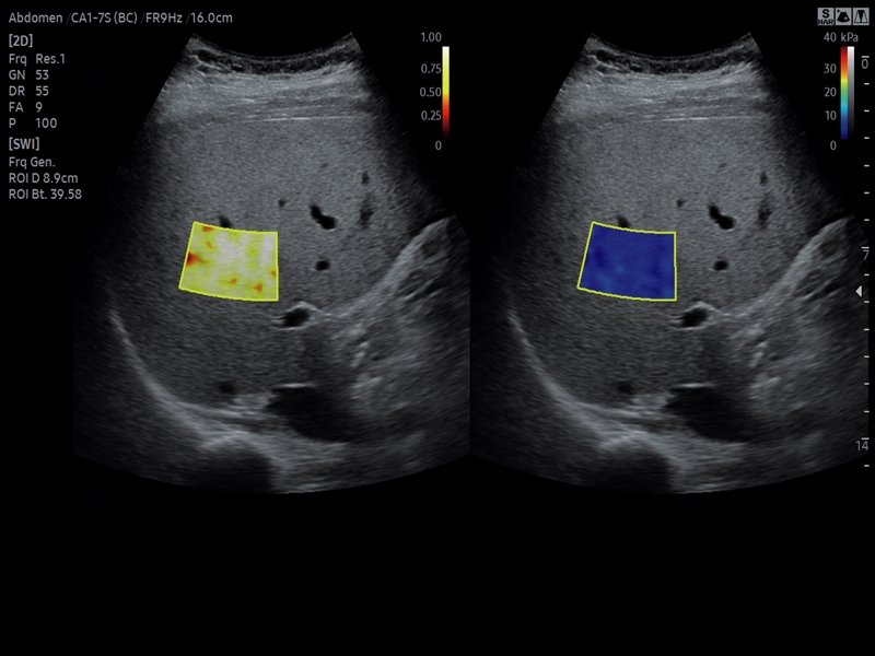 Печень, S-Shearwave (эхограмма №811)