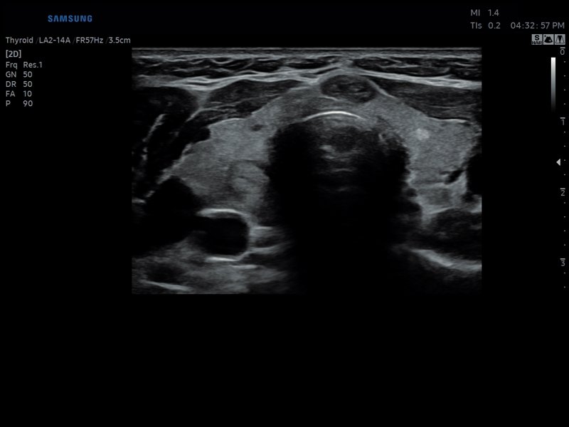 Щитовидная железа, В-режим (эхограмма №812)