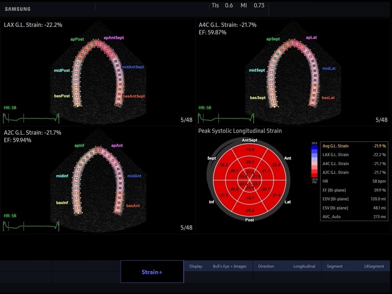 Сердце, Strain+ (эхограмма №817)