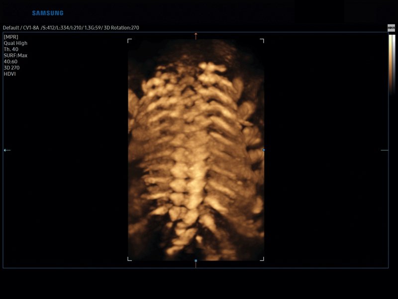 Позвоночник плода, 3D (эхограмма №827)