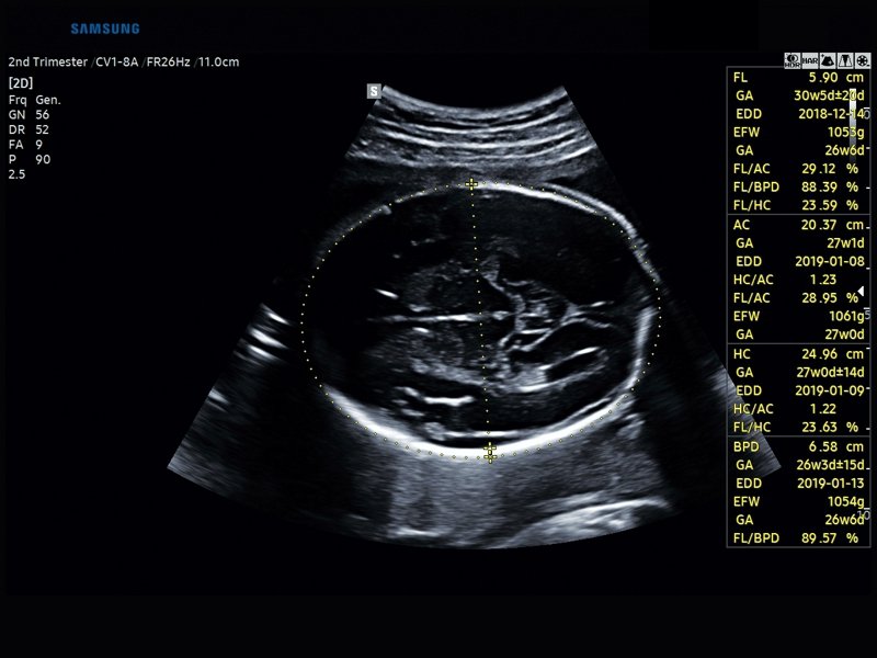 Плод, BiometryAssist (эхограмма №837)