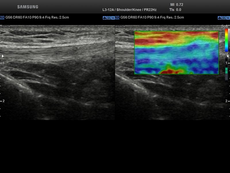 Связка надколенника, Elastoscan (эхограмма №849)