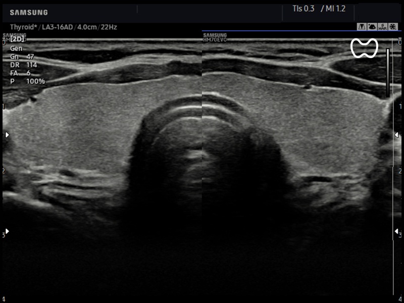 Щитовидная железа, ClearVision (эхограмма №852)