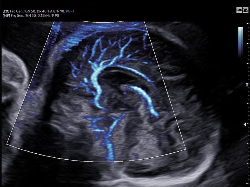 Околомозолистая артерия, MV-Flow (эхограмма №867)