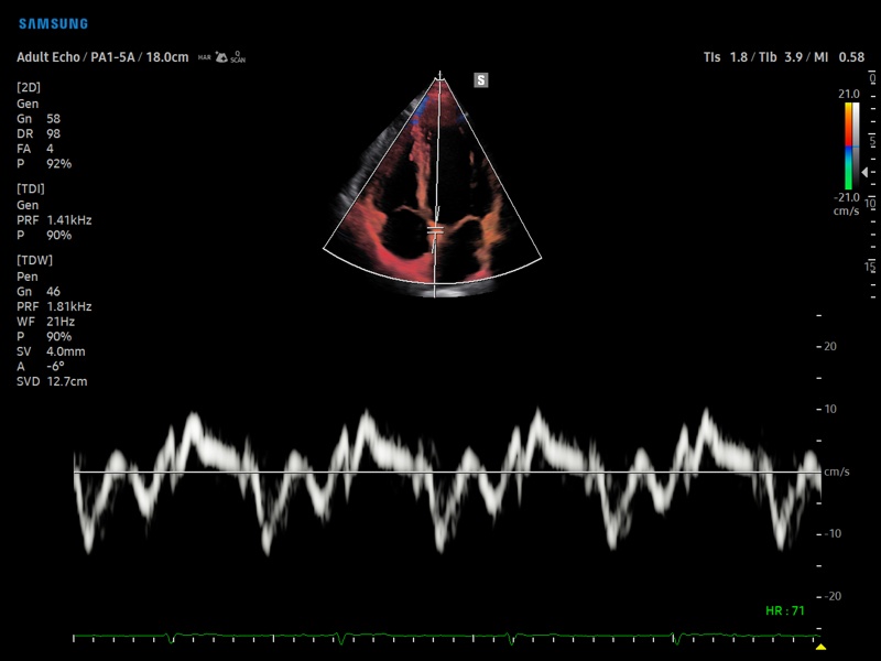 Сердце, тканевой допплер (эхограмма №875)