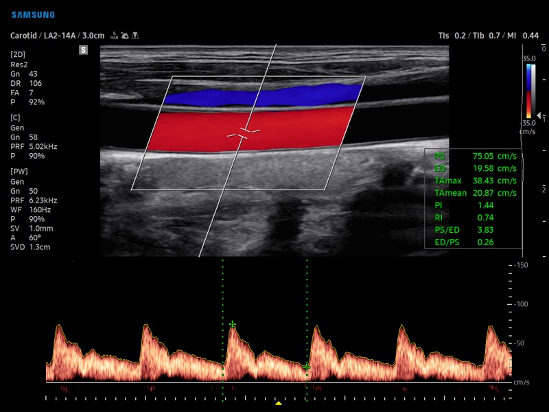 Общая сонная артерия, CFM и PW (эхограмма №876)