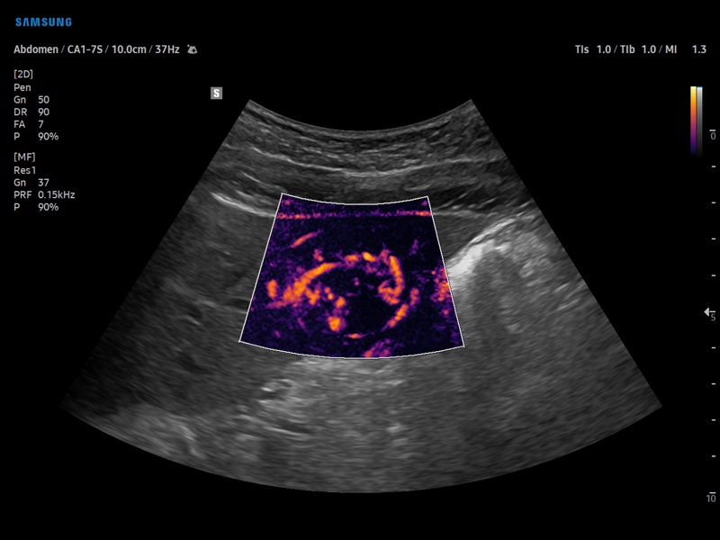 Печень, MV-Flow (эхограмма №893)