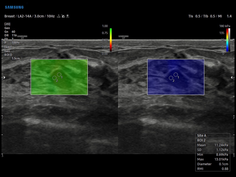 Молочная железа, S-Shearwave (эхограмма №898)