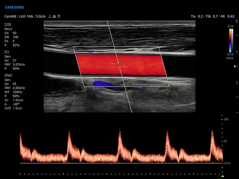 Общая сонная артерия, CFM и PW (эхограмма №899)
