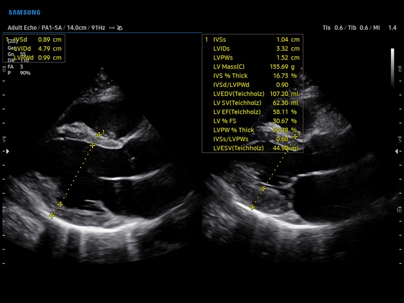 Сердце (длинная ось ЛЖ), B-режим + Assist (эхограмма №900)