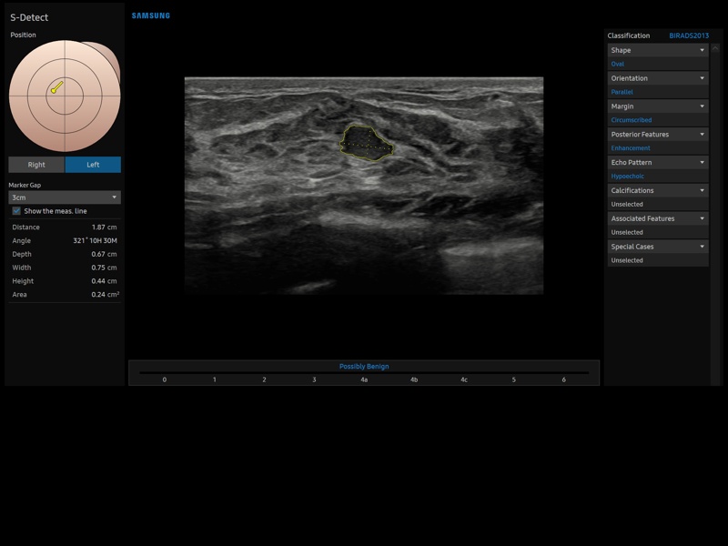 Молочная железа, S-Detect (эхограмма №904)