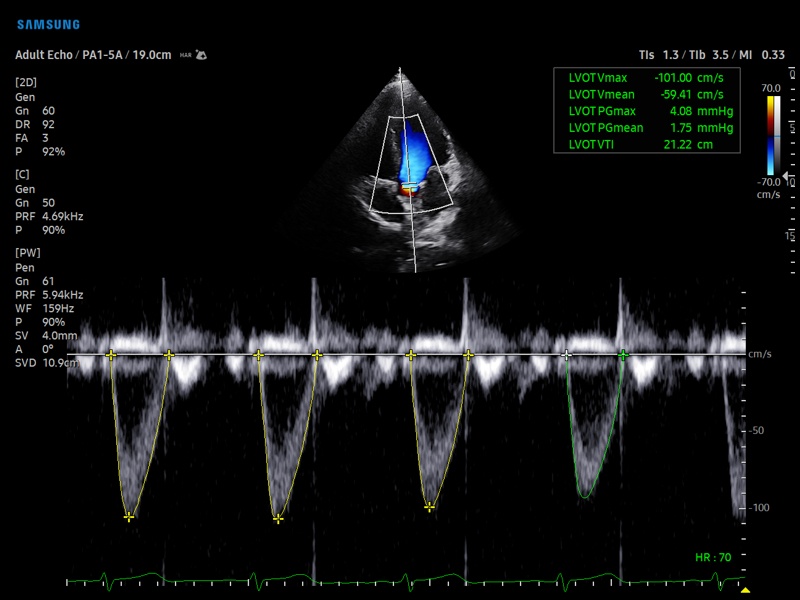Выносящий тракт левого желудочка, HeartAssist (эхограмма №914)