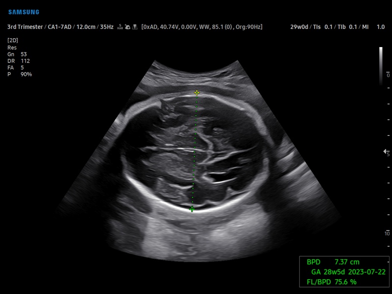 Головной мозг плода, BiometryAssist (эхограмма №921)