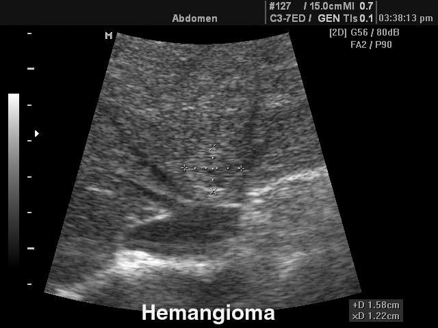 Гемангиома печени, B-режим (эхограмма №101)