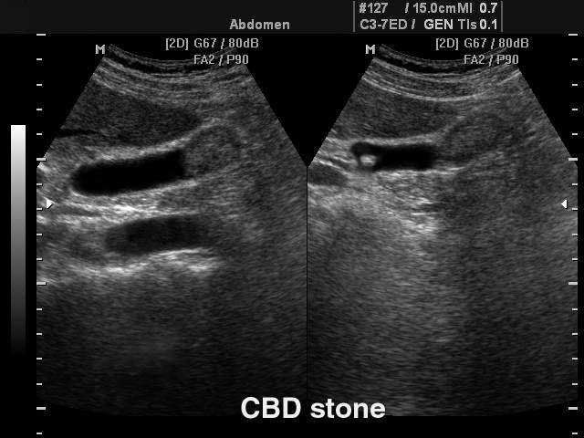 Камень в общем желчном протоке, B-режим (эхограмма №102)