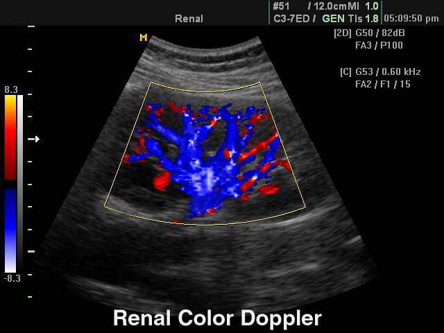Почка, цветное картирование (эхограмма №108)