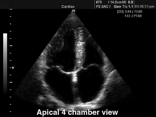 Сердце (4-камерная позиция), B-режим (эхограмма №112)