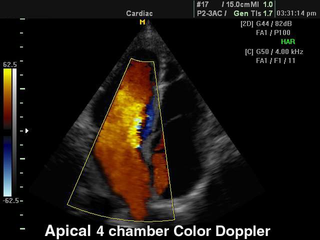 Сердце (4-камерная позиция), цветной допплер (эхограмма №113)