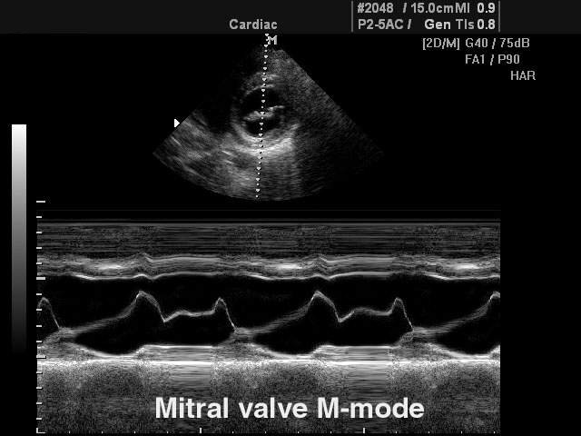 Митральный клапан, М-режим (эхограмма №115)