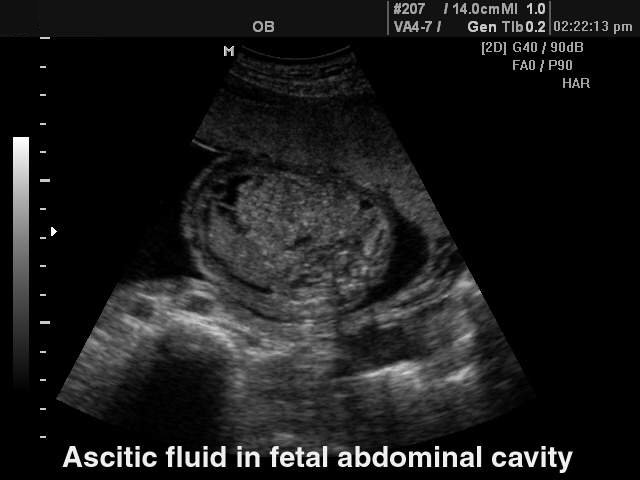 Асцит у плода. Асцит плода на УЗИ эхограммы. Свободная жидкость в брюшной полости на УЗИ.
