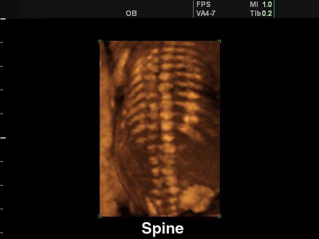 Позвоночник плода, 3D (эхограмма №135)