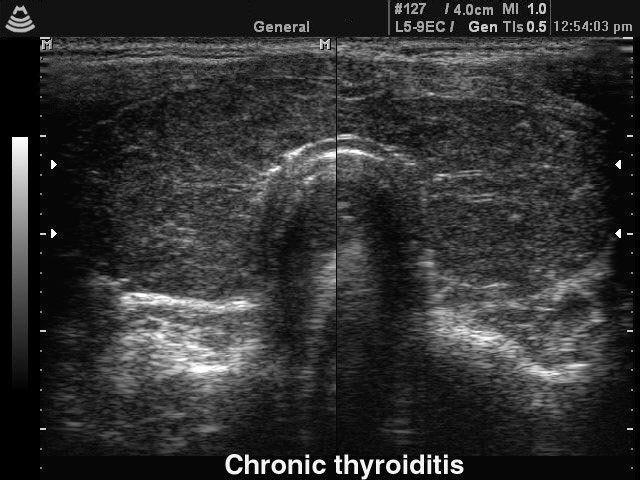 Хронический тиреоидит, B-режим (эхограмма №137)