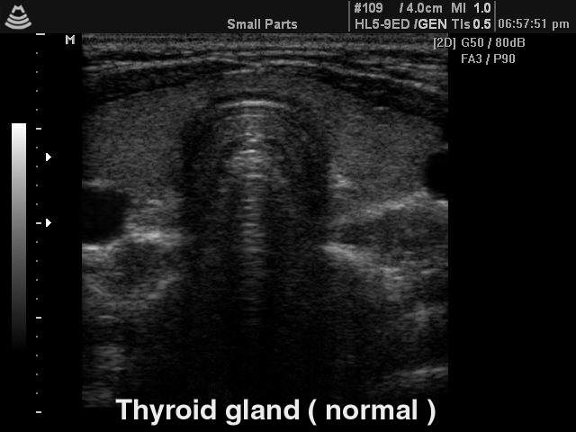 Щитовидная железа - норма, B-режим (эхограмма №138)