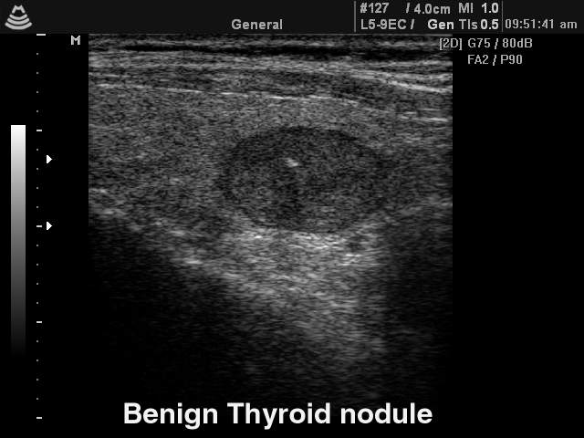 Узел щитовидной железы, B-режим (эхограмма №139)