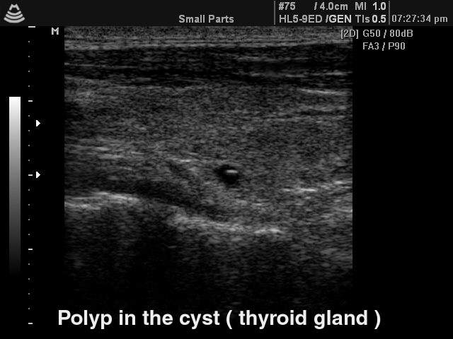 Полип в кисте щитовидной железы, B-режим (эхограмма №140)