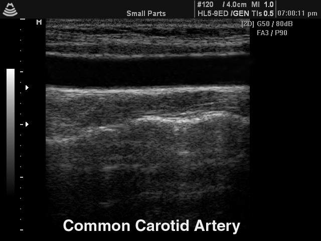 Общая сонная артерия, B-режим (эхограмма №141)