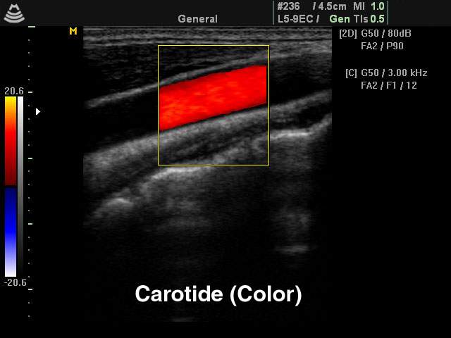Общая сонная артерия, цветное картирование (эхограмма №142)