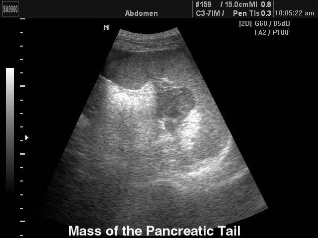 Уплотнение хвоста поджелудочной железы, B-режим (эхограмма №148)