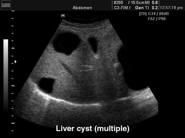 Поликистоз печени, B-режим (эхограмма №152)