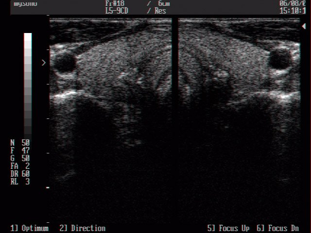 Щитовидная железа, B-режим (эхограмма №16)