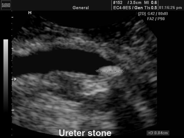 Камень в мочеточнике, B-режим (эхограмма №161)