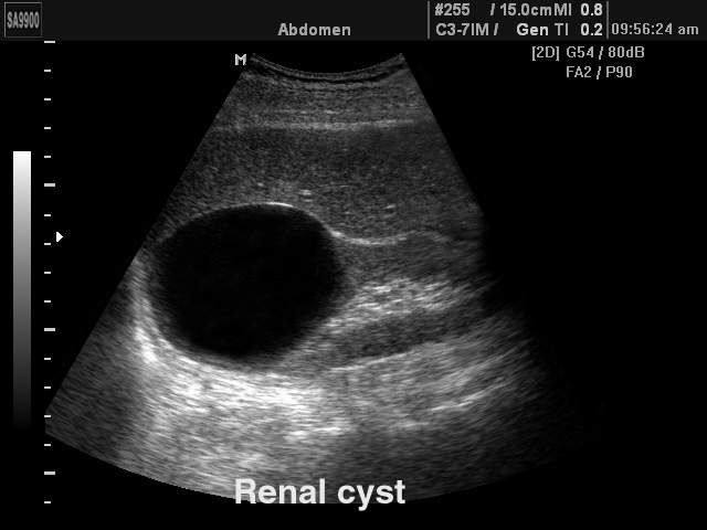 Киста в почке, B-режим (эхограмма №163)