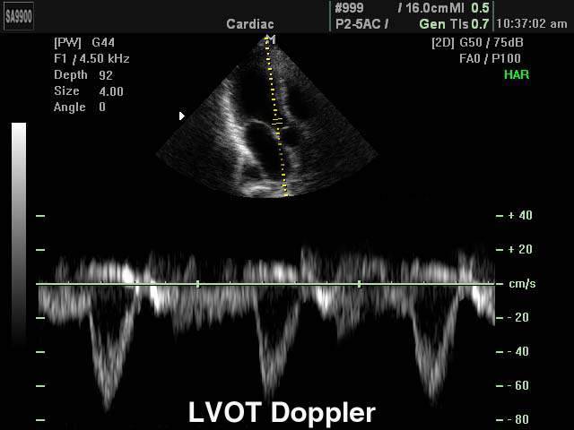 Левый желудочек - выносящий тракт, импульсный допплер (эхограмма №180)