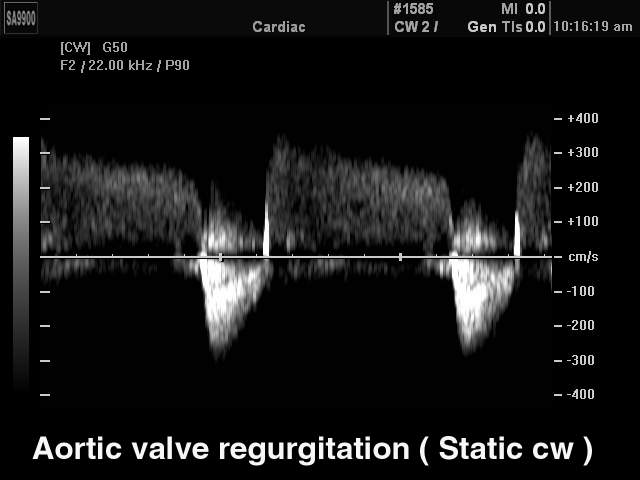 Регургитация аортального клапана, CW (эхограмма №182)