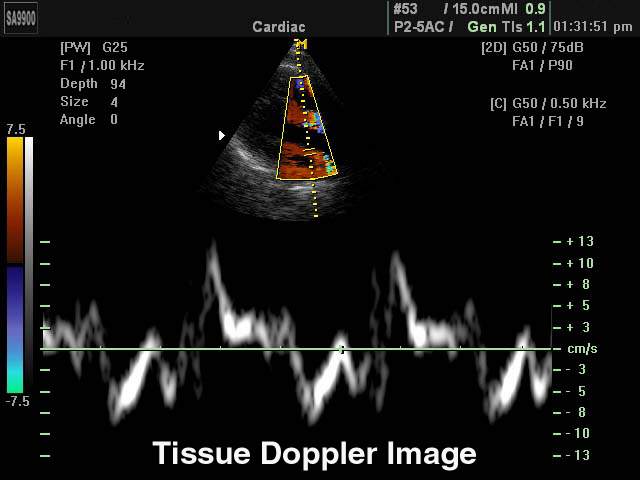 Сердце, CFM и PW (эхограмма №183)