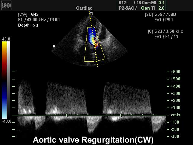 Регургитация аортального клапана, CFM и CW (эхограмма №189)