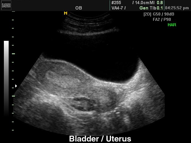 Матка и мочевой пузырь, B-режим (эхограмма №190)