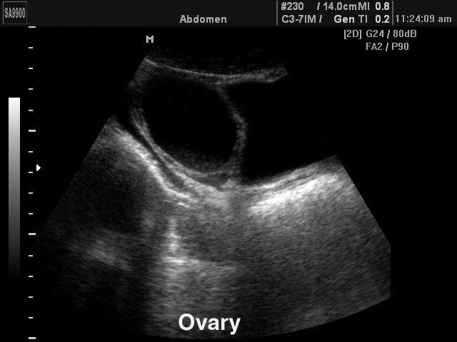 Яичник, B-режим (эхограмма №196)