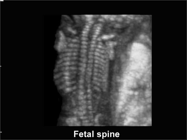 Позвоночник плода, B-режим (эхограмма №203)