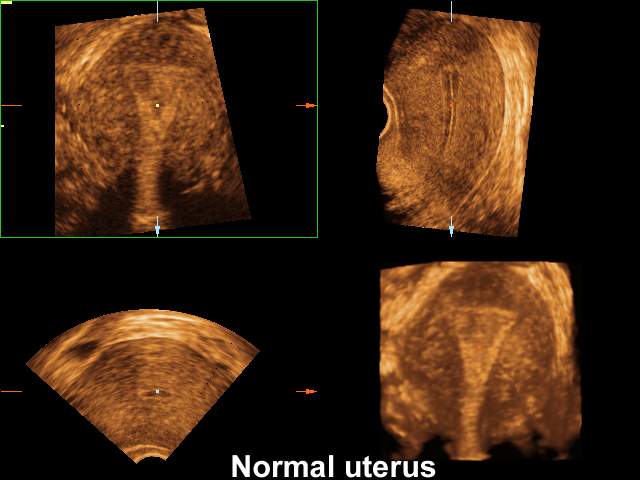 Матка - норма, 3D (эхограмма №205)