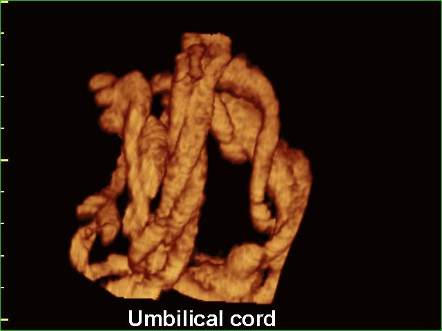 Пуповина, 3D (эхограмма №211)
