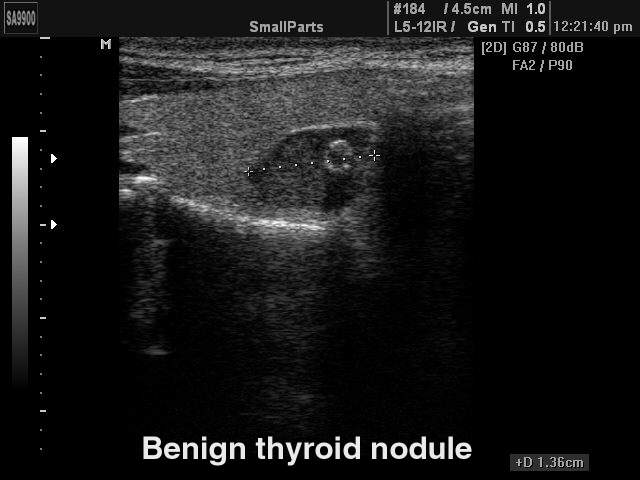 Доброкачественный узел щитовидной железы, B-режим (эхограмма №215)