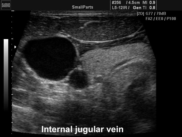 Внутренняя яремная вена, B-режим (эхограмма №217)
