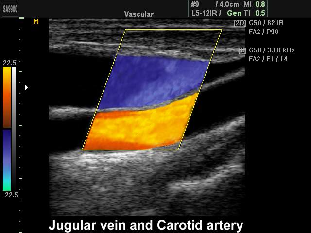 Яремная вена и сонная артерия, цветное картирование (эхограмма №218)